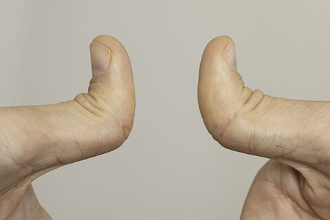 thumbs double jointed person hypermobility skeletal hand joints ability bend thumbs backwards